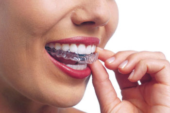 Invisible (Clear) Orthodontic Appliances