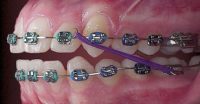 How to wear elastics and rubber bands with braces