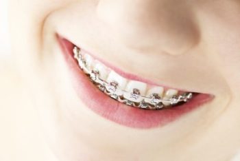 Traditional Metal Braces at Katy ClearChoice Orthodontics